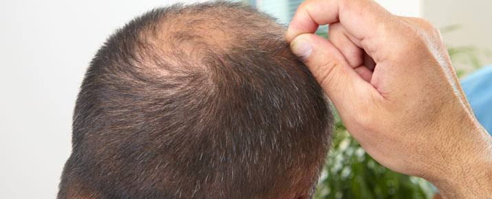 Efficacité du Trioxidil anti-chute de cheveux
